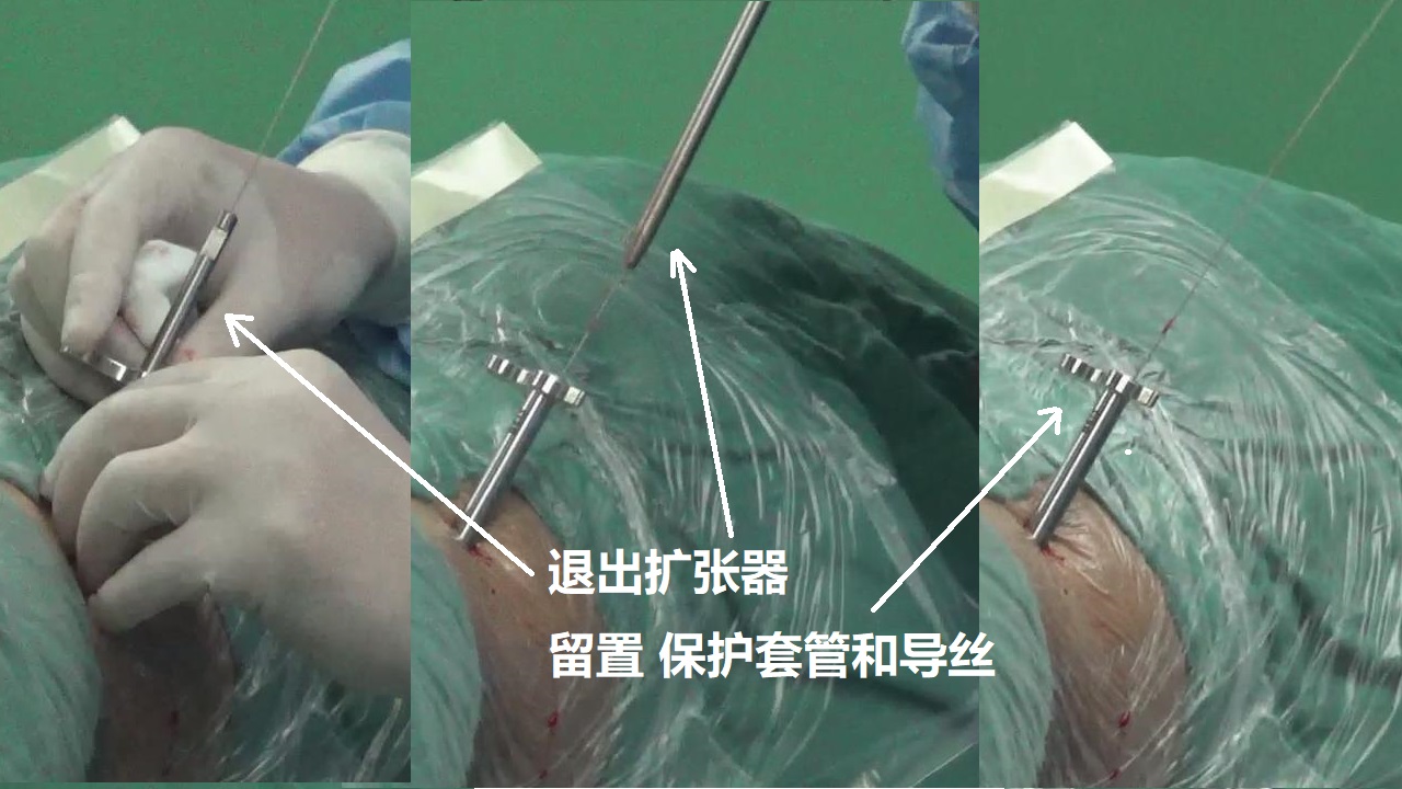 8-退出扩张器-留置保护套管和导丝.jpg