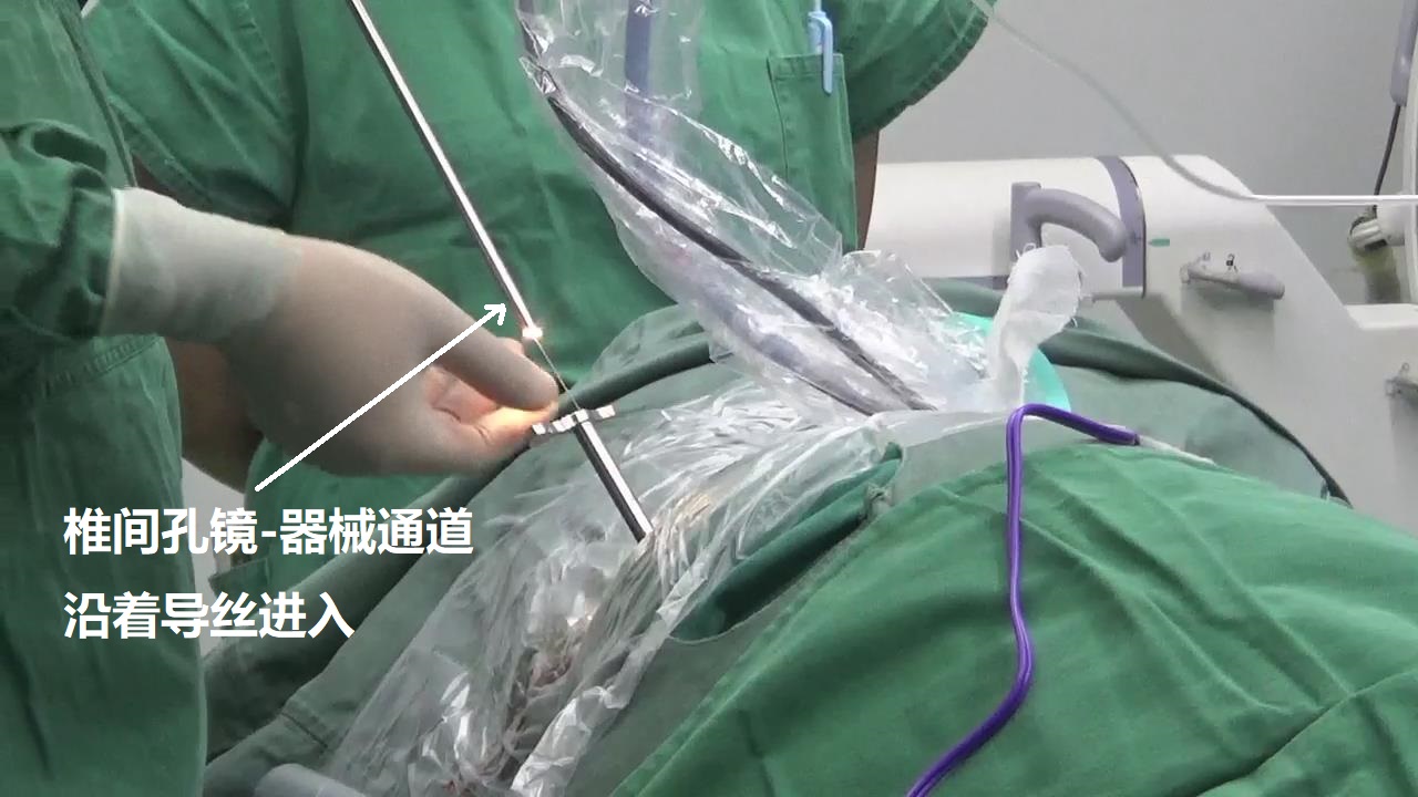 9-椎间孔镜-进入.jpg