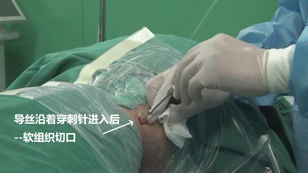 4-导丝进入-皮肤肌肉切口.jpg