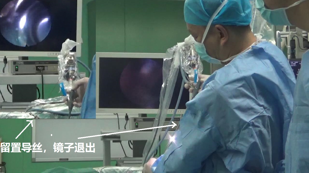 14-留置导丝，镜子退出.jpg