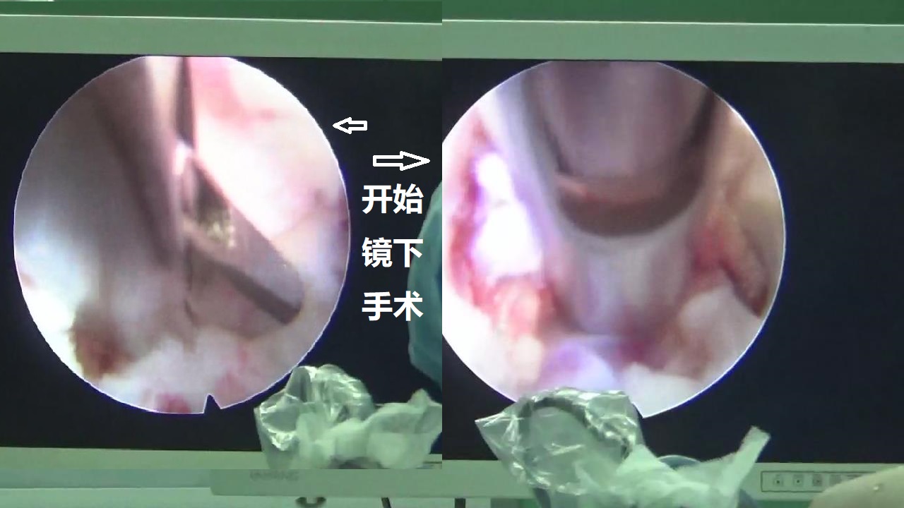 18-开始镜下手术.jpg